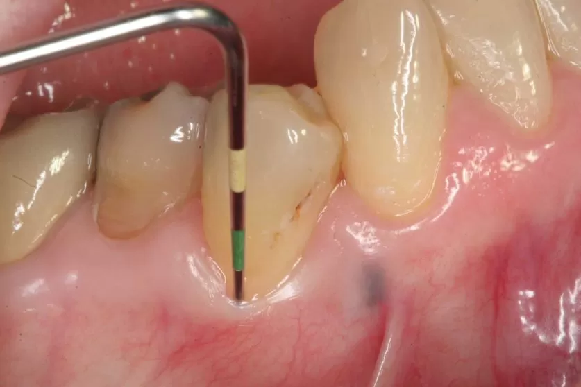 Periodontitis Treatment