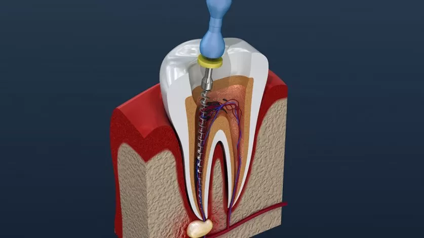 Root Canal