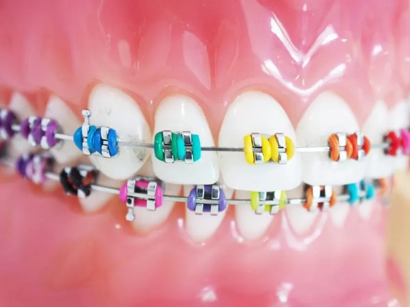 Braces color wheel