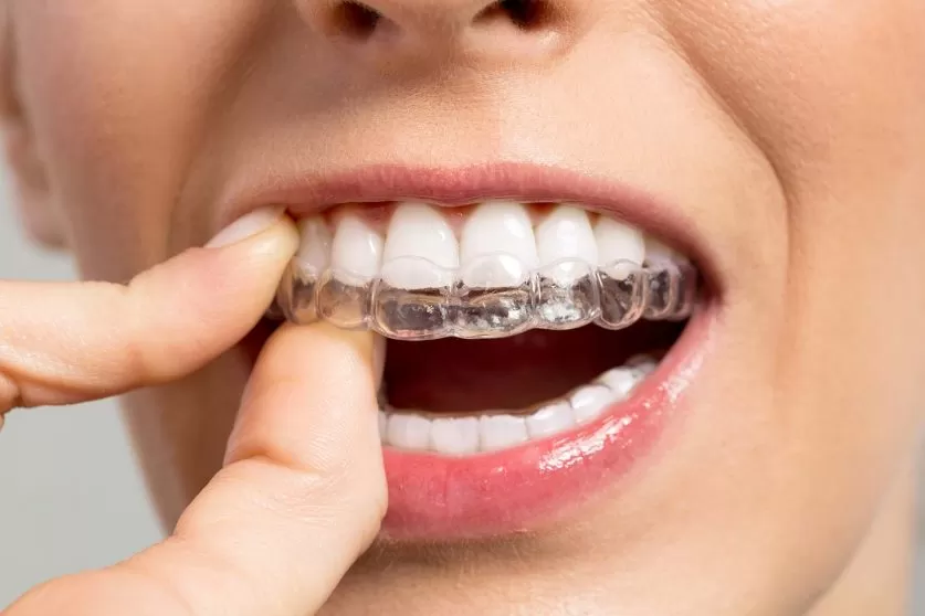 braces alternative