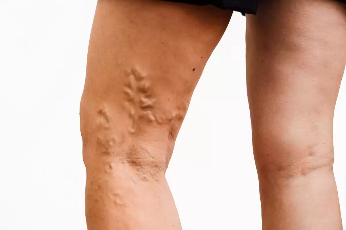 Varicose Veins