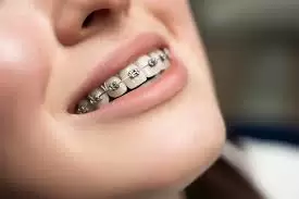 Braces