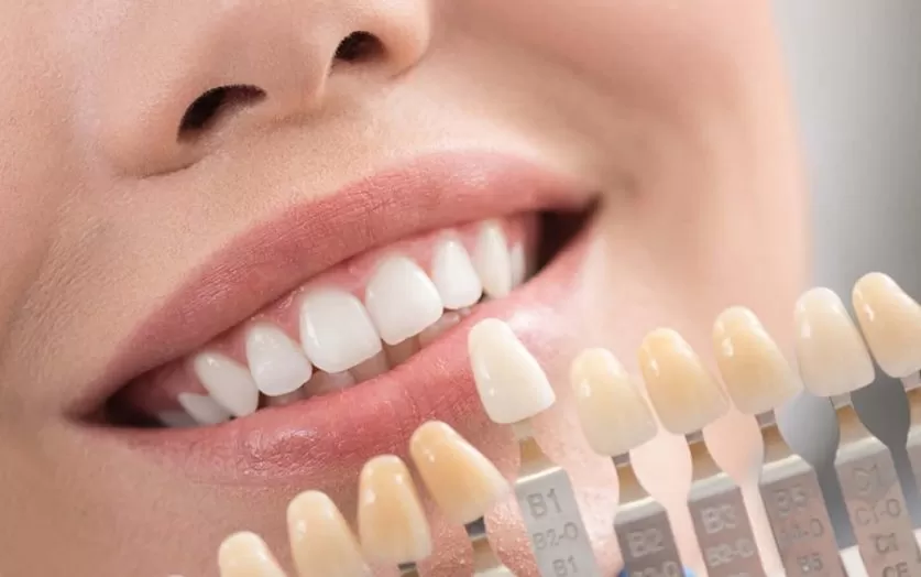 Dental Veneers