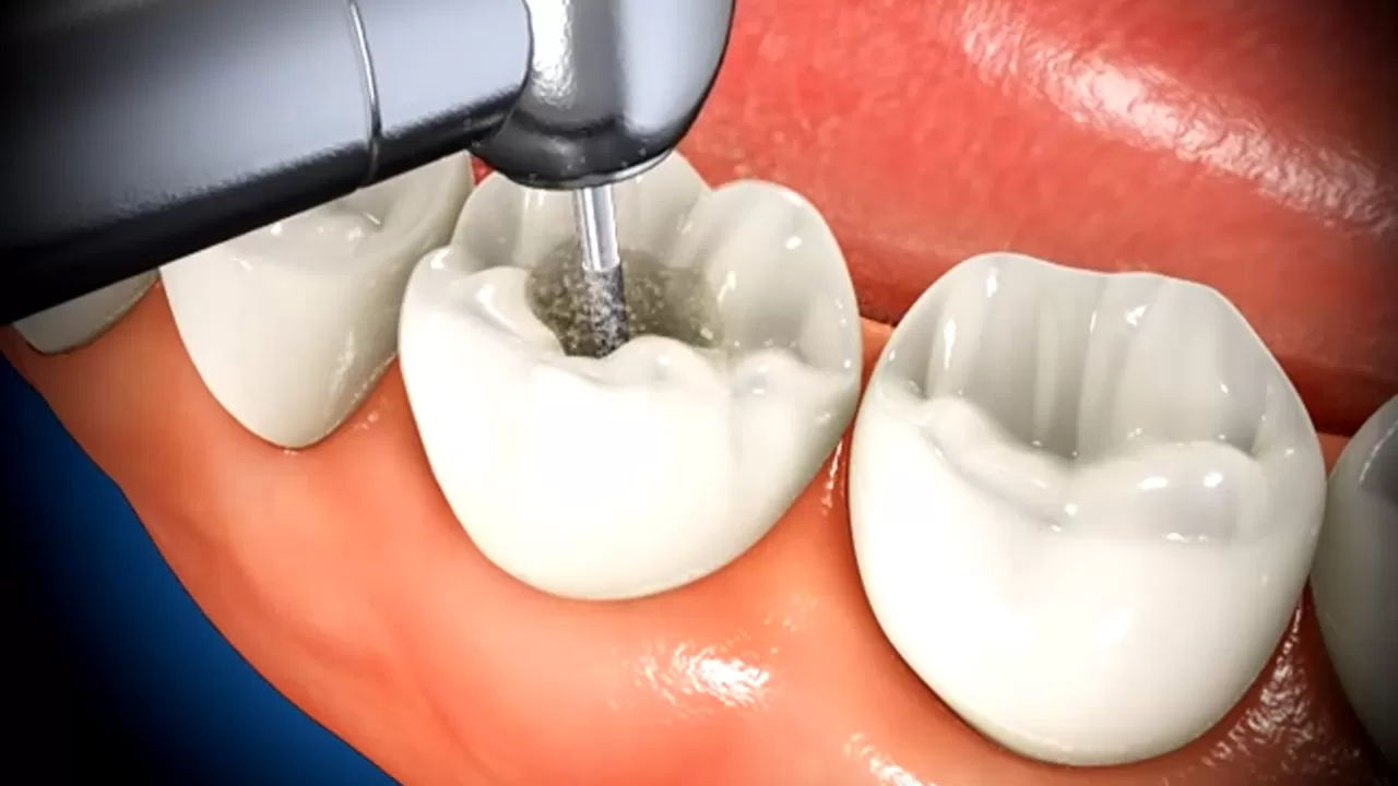 Root Canal Treatment