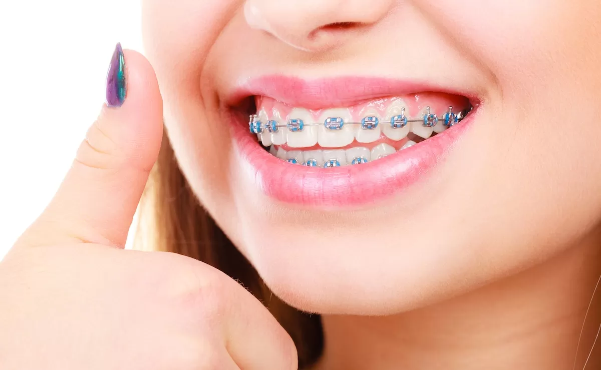 braces colors