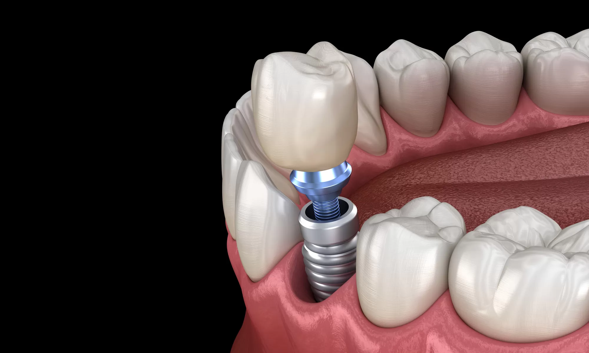 Affordable Dental Implants