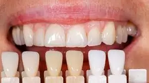 porcelain veneers near me in Houston