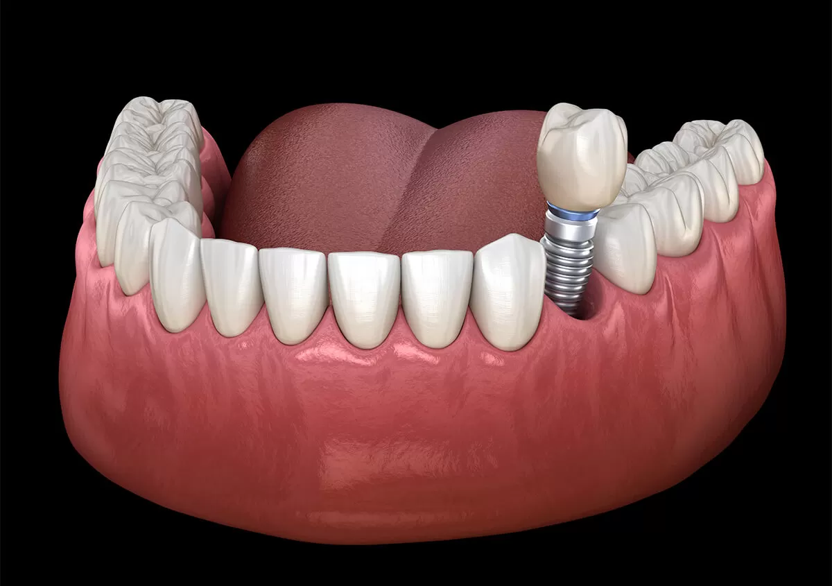 dental implants near me